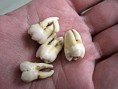 /album/wisdom-teeth/wisdome-tooth-4-jpg/